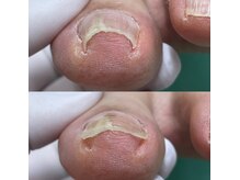 巻き爪補正店 豊田店/【巻き爪/陥入爪】