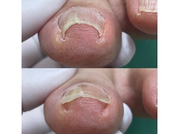 巻き爪補正店 豊田店/【巻き爪/陥入爪】