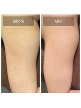 ビビ(VIVI)/二の腕毛孔性苔癬に