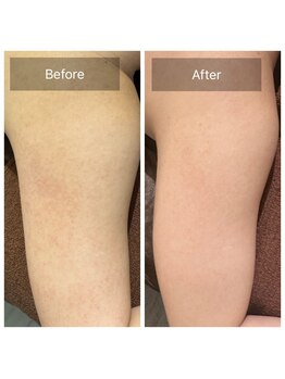 ビビ(VIVI)/二の腕毛孔性苔癬に