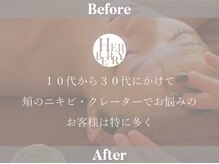 ハーバリー ハーブピーリング 岐阜(HERBERRYハーブピーリング)/ハーブピーリング専門店HERBERRY