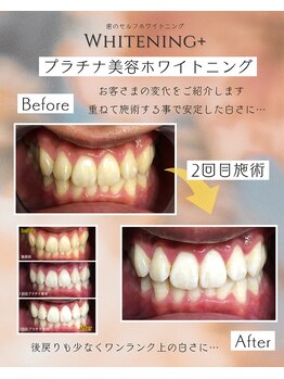 ホワイトニングプラス(Whitening+)/プラチナ美容ホワイトニング