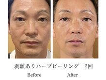 メンズミーシェ(Men's Meshie)/リベルハーブピーリング