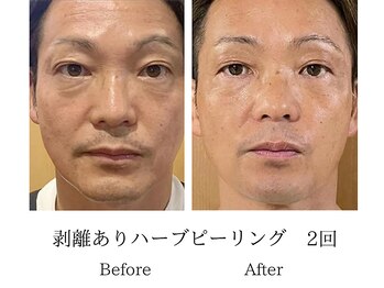 メンズミーシェ(Men's Meshie)/リベルハーブピーリング