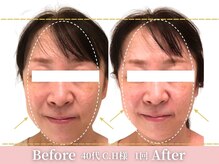 アメリイ 百合ヶ丘 新百合ヶ丘(Amerii)/小顔矯正1回50代たるみスッキリ