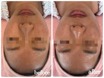 シルク(Cilk)/毛穴洗浄＋ハーブピーリング