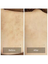 ビビ(VIVI)/背中のざらつき・かゆみにも◎