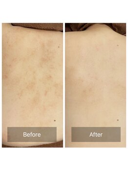 ビビ(VIVI)/背中のざらつき・かゆみにも◎