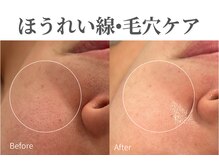 エトレ(etre)/ほうれい線/毛穴/カーボキシー