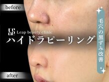 リープ(Leap)/ハイドラピーリング