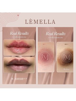 マリナビューティーサロン(Malina BEAUTY SALON)の写真/【★韓国ルメラ×唇・乳輪】予約人気No.1。色素沈着した黒ずみを除去し、血色感のある愛されピンク肌へ