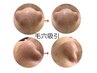 【スッキリ・ツルツル】3箇所集中毛穴吸引ケア
