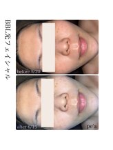 ペア(pe'a)/BBL光フェイシャルbefore★after