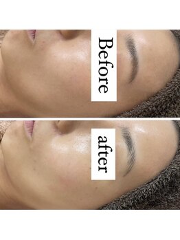 カルディエ(Cardie)/肌質改善　ビフォーアフター