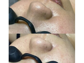 神の癒し/鼻黒ずみ吸引毛穴洗浄小顔コルギ