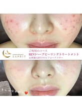 エスプリ 銀座店/ハーブピーリング銀座