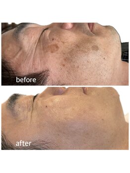 マイルーチェ 可児川合店(MyLuce)/本気でシミ改善