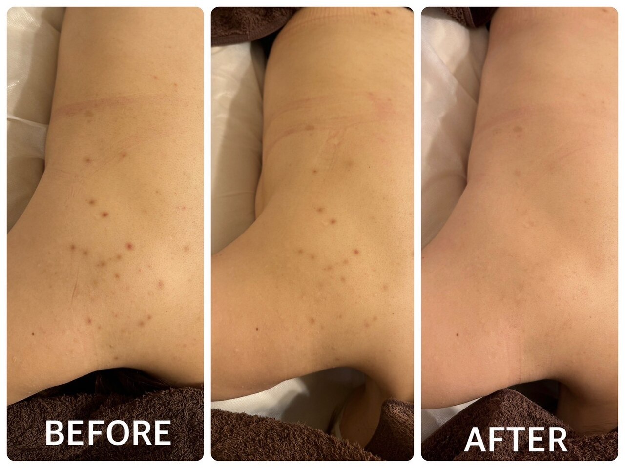 ハーブピーリング 心斎橋｜ホットペッパービューティー