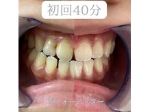 ホワイトニングショップ 長岡京店/【初回ビフォーアフター】美白