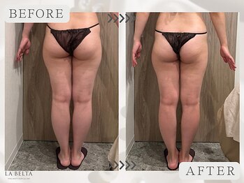 エステティックサロン ラ ベルタ(Esthetic Salon La Belta)/セルライトゼロ