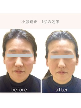 ミニン(minin)/小顔矯正