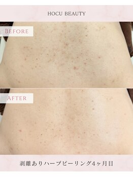 ホクビューティー(HOCU BEAUTY)/【背中/ハーブピーリング】
