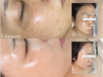 リトルーム(Litroom: from Seoul)/確実に肌が変わっていく手応え