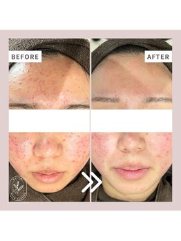ハルミハーブピーリング 池袋店(Harumi Herb Peeling)/