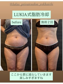 ルキア(LUKIA)の写真/LUKIA式脂肪冷却は一気になりたいを叶える！同時８カップ施術。どうしても痩せない箇所にこそやってみて