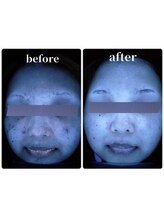 ザ フェース 京都御池店(THE FAITH)/お客様のお肌変化