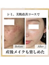ココ(KOKO)/1回での変化!産後の肌変化に対応