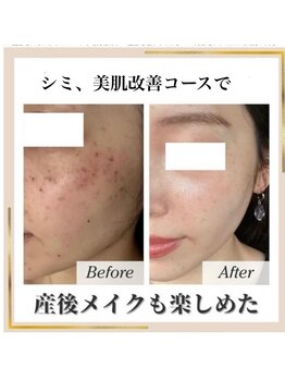 ココ(KOKO)/1回での変化!産後の肌変化に対応