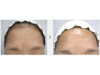 Nビューティー/最新RFサーモシェイプオーパス