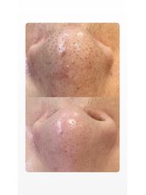 ソリッジ肌管理室/毛穴徹底ケア