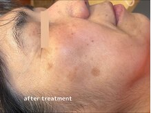 オアシスラグーン(OASIS LAGOON)/シミケア（症例５：after）