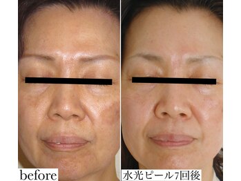 メゾリーナ(MAISOReNA)/水光ピーリング