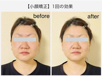 ミニン(minin)/小顔矯正