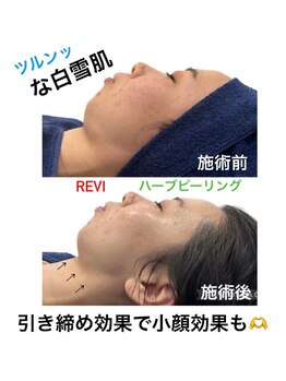 シャルム(CHARME)/REVIハーブピーリング