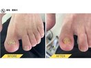 肥厚爪ケア