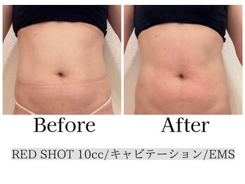 エトワール(etoile)の写真/【キャビゼロ使用】自信が持てるすっきり二の腕を目指す◇“キャビテーション×痩身ケア“でWアプローチ!!