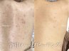 【大人気★背中ハーブピーリング】ニキビ・ザラつき・毛穴ケア◎