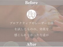 ハーバリー ハーブピーリング 岐阜(HERBERRYハーブピーリング)/ハーブピーリング専門店HERBERRY