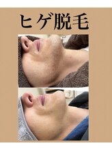 ヴィアージュ/剃る手間・肌荒れもサヨウナラ