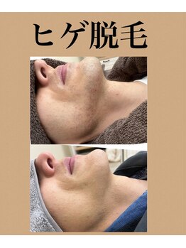 ヴィアージュ/剃る手間・肌荒れもサヨウナラ