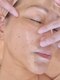 サクラス(SUQRAS)の写真/【コラーゲン繊維導入】メスを使わないリフトアップ施術でシワとたるみを徹底ケア♪