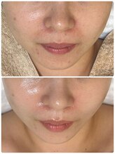 ジェニー(JENNI)/韓国ピーリング×エクソソーム