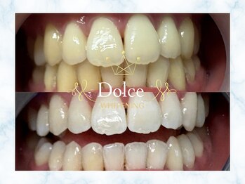 ドルチェ(Dolce)/ビフォーアフター