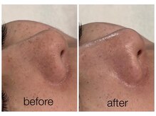 ハリスキンラボ(Hari.Skin.Lab)/40代のお客様/1回での施術効果