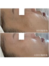 サロンドジョリー/ハーブピーリング