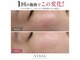 ヴィシア(VIXIA)の写真/【美肌ケア】本気で肌悩みを改善したい方にオススメのサロン